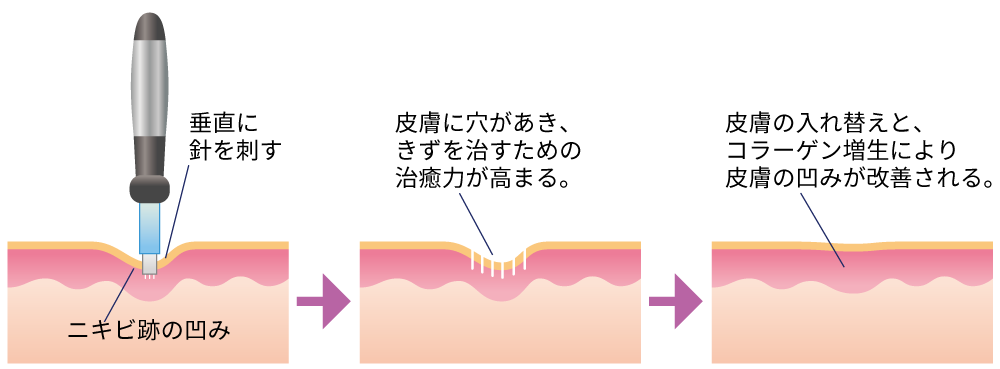 ダーマペン