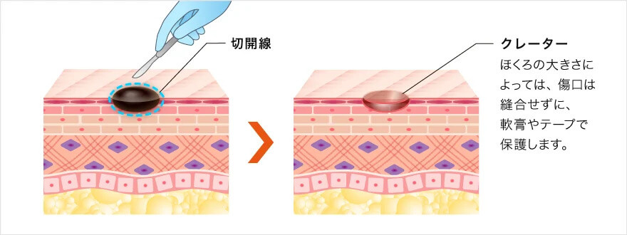 くりぬき法でのほくろ除去