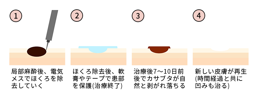 電気メスでのほくろ除去