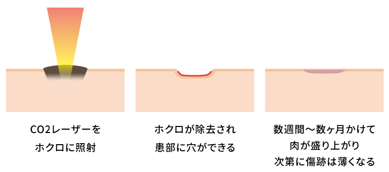 炭酸レーザーでの施術