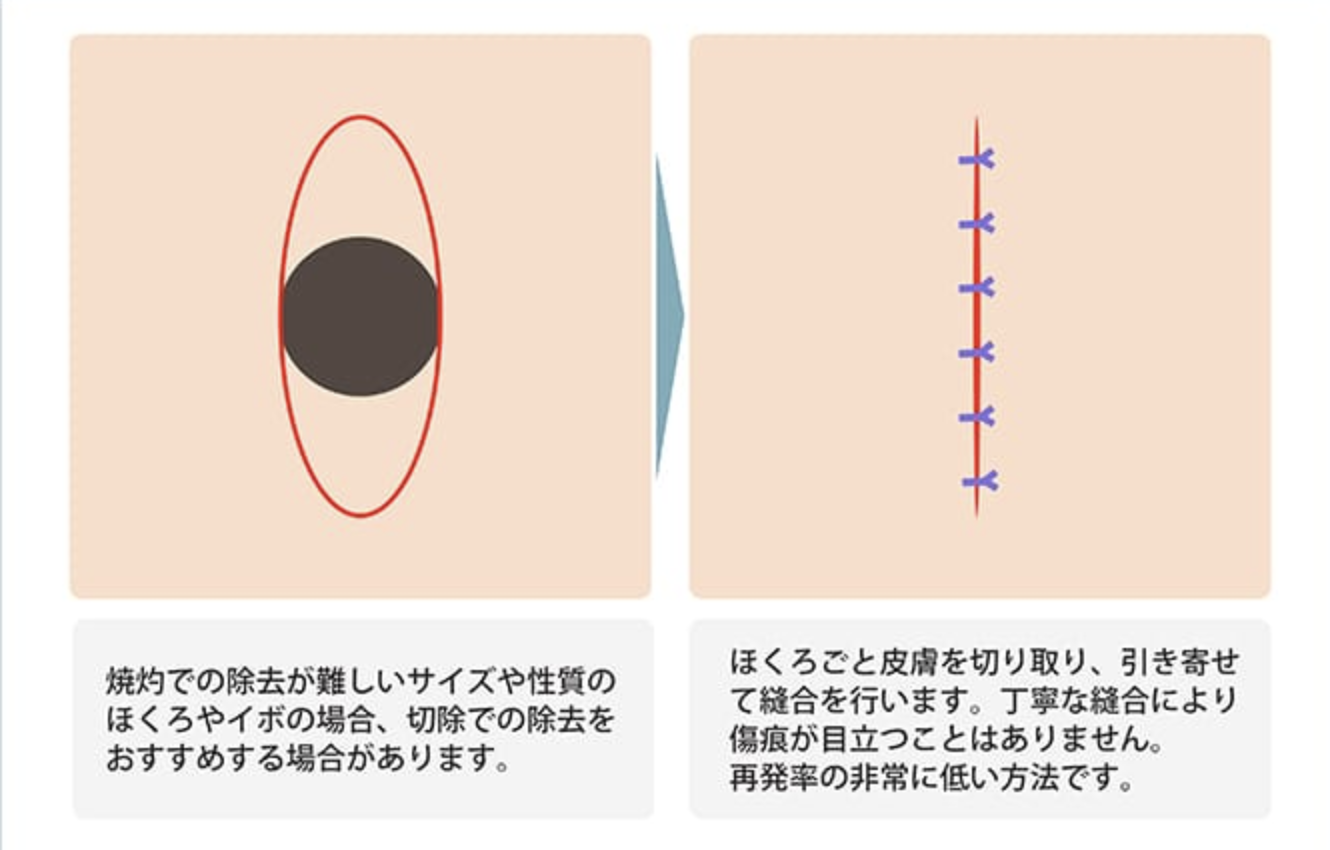 ほくろの除去